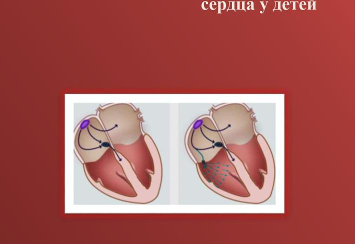 Синдром преждевременного воз-буждения желудочков сердца у детей