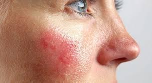 Проблемы  лечения и профилактики заболеваний кожи при спортивной деятельности в условиях жаркого климата